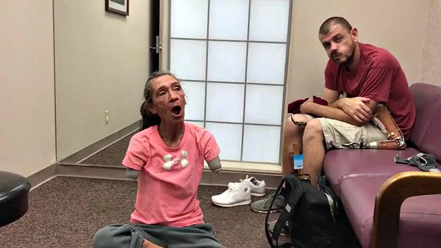 mature double arm amputee